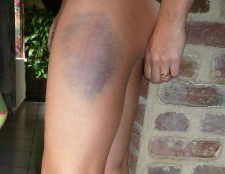 Accident de hamac....